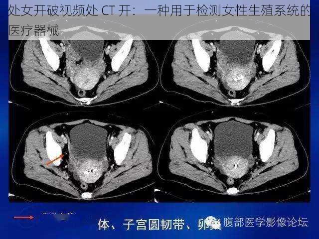 处女开破视频处 CT 开：一种用于检测女性生殖系统的医疗器械