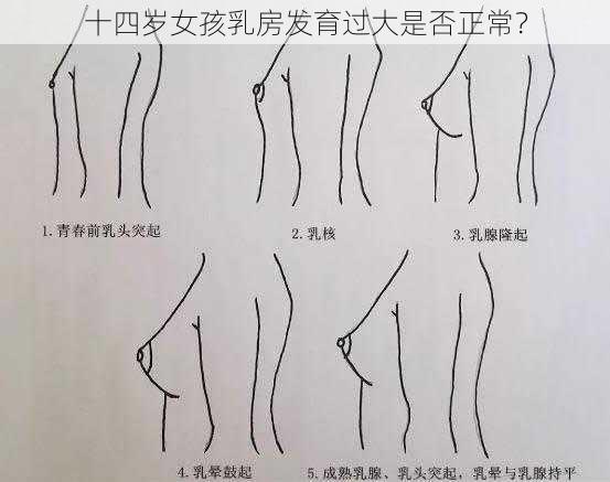 十四岁女孩乳房发育过大是否正常？